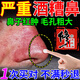 酒糟鼻專用紅腫長痘草莓紅鼻子血絲痤瘡膏(藥監(jiān)備案)貼 買2送1【鼻子紅腫長痘紅血絲】周期裝 酒槽鼻酒渣鼻鼻頭粉刺黑頭螨蟲（發(fā)貨特效率）