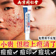 南京同仁堂祛痘膏祛痘印修復淡化痘印痘坑學(xué)生青春痘閉口粉刺去痘痘和痘印 特價(jià)一盒（祛痘真的快）