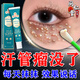 汗管瘤專(zhuān)用點(diǎn)藥水眼部脂肪粒油脂粒扁平疣白色顆粒去除 1盒