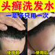 洗發(fā)水頭皮癬頭部牛皮癬脂溢性皮炎治銀屑i病去屑止癢頭皮外用液 三盒裝[買二送一]