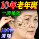377祛斑霜老年斑專用一夜消強(qiáng)力祛除藥手背祛斑專用霜去老人黃褐斑雀 60g 【買二贈一 輕度斑點(diǎn)】3盒