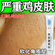 雞皮膚疙瘩毛囊角化癥專(zhuān)用藥 雞皮膚去除器神專(zhuān)用藥毛囊角質(zhì)疙瘩大腿皮膚干燥水楊酸軟膏 1支【雞皮膚影響形象】