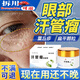 鄒潤安汗管瘤專(zhuān)用眼部去除神器藥膏脂肪粒去除神器眼周用去油脂粒小顆粒 買(mǎi)二送一【周期裝】可試用1盒