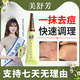 美舒芳祛痘霜新品調理痘痘粉刺快速有效