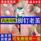 老繭軟化膏繭子去除腳底厚繭死皮角質(zhì)腳趾腳釘雞眼手指頭關(guān)節硬皮溶解角質(zhì)足部厚繭膏 一盒裝【建議按周期裝選購】