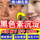 臉部排毒排黑色素去斑去黑色素沉淀臉上黑斑點(diǎn)黑色素去除臉部醫用色素下暗沉關(guān)節大腿根黑去黑藥膏維A酸乳膏 1盒【維a酸i乳膏 祛斑專(zhuān)用藥臉部】