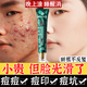 百幽草南京同仁堂 水楊酸祛痘膏痘痘印痘坑呵護痘肌亮膚青春痘男女通用 【一支裝】 30g