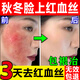 去紅血絲修復(fù)角質(zhì)層薄敏感肌修復(fù)屏障受損秋冬季節(jié)臉部敏感肌膚霜 舒緩修護(hù)霜*1盒裝