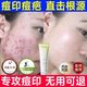 HIEUAILR祛痘印去痘坑去痘疤痘印痘坑修護復凹洞黑色素沉淀淡化洗面奶 一盒體驗裝【專(zhuān)攻痘印】