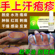 汗皰疹用藥手上起小水泡脫皮手癢 消炎止癢藥膏抗真菌脫皮瘙癢難忍真菌感染效 鹽酸特比萘芬噴霧劑 2盒【手上小水泡瘙癢】