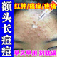 青春期額頭上長痘痘粉刺藥膏全身毛囊炎祛痘膿包瘡滿背痘痘痤瘡紅腫瘙癢疼痛去背上痘痘 維A酸乳膏 1盒【背上長痘】祛痘藥膏