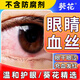 葵花紅血絲眼藥水眼睛充血眼紅專(zhuān)用滴眼液緩解眼干澀發(fā)癢結膜充血疲勞 2瓶【單瓶?jì)H需39元】 紅血絲專(zhuān)用滴眼液15ml