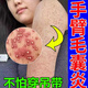 手臂毛囊炎長痘痘胳膊上的小疙瘩專用膏雞皮疙瘩膿包毛囊堵塞有黑點(diǎn)后背長痘痘真菌感染螨蟲雞皮膚外用可搭藥 單盒體驗(yàn)裝