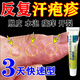 汗皰疹100%特有效藥濕疹特有效藥止癢去癢根手上起水泡癢用什么藥真菌感染抑菌膏復(fù)方倍氯米松樟腦乳膏 1盒【手上起小水泡手指真菌感染】不花冤枉錢
