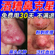 酒糟鼻專(zhuān)用紅鼻子藥膏玫瑰痤瘡草莓鼻修復去除神器鼻頭粉刺去黑頭 三盒裝【療程裝98%人選擇】