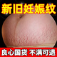 祖醫堂妊娠紋修復產(chǎn)后去除消除醫用退熱凝膠緊致肚皮霜淡化生長(cháng)紋李時(shí)珍 1盒裝 每日兩次 30天有效淡紋肥胖紋色素沉淀