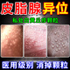 皮脂腺異位癥私處男女皮脂腺囊腫增生陰囊陰小疙瘩白點(diǎn)增生噴劑 1盒裝【皮脂腺異位】多買(mǎi)多送
