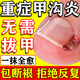 宮本田中甲溝炎專用的藥根治消腫去肉芽化膿感染去除息肉指甲長肉里藥膏 單盒【甲溝炎藥膏】