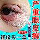 神經(jīng)性皮炎專(zhuān)用藥膏眼角上長(zhǎng)癬皮膚劇烈瘙癢皮膚變厚皮炎濕疹眼皮干癢起皮過(guò)敏泛紅止癢糠酸莫米松乳膏 5盒裝【癢的抓出血 癬多出不去門(mén)】