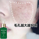 臻羞毛孔收斂精華液毛孔粗大去黑頭細致毛孔縮小舒緩補水保濕毛孔精華 兩瓶100ml【輕微毛孔】