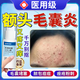 藤石制藥兒童額頭上長(cháng)小粒痘痘面部毛囊炎毛孔堵塞頭皮上長(cháng)痘臉頰痘痘CN 藥監備案【一盒裝】額頭痘痘毛囊炎