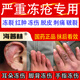 海普林凍瘡止癢凍傷膏特專(zhuān)用效膏肝素鈉乳膏凍瘡修復防止干裂手腳后跟開(kāi)裂疼痛瘙癢凍傷膏耳朵臉部手指凍傷 1盒【輕度凍瘡 遇冷疼痛】