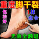 秋雅奈緒正品手腳裂膏腳后跟干裂開(kāi)裂專(zhuān)用膏藥真菌脫皮干燥手足皸裂龜裂膏 單盒【腳后跟冬天裂口滋潤膏防干裂起硬皮】 冬天干裂起硬皮開(kāi)裂足跟皮膚粗糙感染防裂滋潤膏
