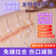 悠痕減張器疤痕九院同款祛痣手術剖腹產兒童傷口吻合器減張貼腹壁手術 【呵護版】3.5cm 3扣3片裝