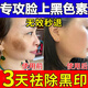 臉上黑色素沉淀去除專(zhuān)用膏面部曬斑痘印黑斑點(diǎn)黑色素沉著(zhù)可搭產(chǎn)品去除臉部皮膚暗沉發(fā)黑美白熊果苷軟膏 一盒體驗裝