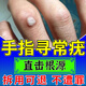 【日本品牌】醫(yī)用去手指疣尋常疣除膏專用神器刺猴膏清寧可搭藥BD 送醫(yī)用棉簽【一盒裝】輕度小面積疣體
