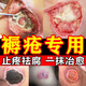 褥瘡特治療效藥褥瘡膏傷口愈合去腐生新肌褥瘡藥老人臀部外用褥瘡潰爛抑菌壓瘡特新期效藥防褥瘡紅霉素軟膏 1盒【長(cháng)年頑固褥瘡】建議多盒