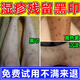 濕疹淡化黑印專(zhuān)用膏去除濕疹疤痕腿部臉脖濕疹黑印黑斑修復淡化黑印專(zhuān)用膏除兒童腿上后背痘印疤印醫用非藥膏 單盒體驗裝
