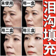 眼窩淚溝填充神器臉部凹陷填充液面部豐盈修復凹坑太陽(yáng)穴膠原蛋白 臉部填充【支持試用】 30ml 5瓶裝