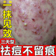阿達(dá)帕林凝膠醫(yī)用祛痘消炎痤瘡專用藥膏去痘痘和痘印閉合性粉刺藥膏臉上長痘痘治療重度青春痘硬疙瘩皮膚用藥 1盒裝【粉刺膿包痘印】
