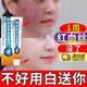 內廷上用用去紅i血絲修復角質(zhì)層薄敏感肌修復去除臉上紅血絲泛紅發(fā)燙屏障 【臉部泛紅脫皮干】1盒
