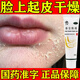 [三順] 參皇軟膏臉干燥起皮藥膏脂溢性皮炎面部臉上起皮干燥男士臉部干燥起皮冬季皮膚干燥止癢潤膚 1盒裝【皮膚干燥起皮】