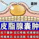 皮脂腺囊腫專用藥膏化膿去膿包皮脂腺囊腫膏去除皮下痘痘粉瘤增生結(jié)節(jié)痘硬塊臉部耳朵皮下囊腫 莫匹羅星軟膏 2盒【皮脂腺囊腫 膿包 癤腫】