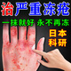 秋雅奈緒日本進(jìn)口凍瘡膏止癢凍傷膏專(zhuān)用耳朵臉部手指足修護消腫防凍皸裂膏 一盒體驗裝特效膏