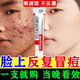 阿達帕林凝膠醫用祛痘消炎痤瘡專(zhuān)用藥臉上長(cháng)玫瑰痤瘡硬疙瘩粉刺去痘痘和痘印青春痘祛痘藥膏特治療效皮膚用藥 1盒【臉上長(cháng)痘】醫用級 祛痘藥膏