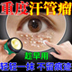 汗管瘤眼部去除油脂粒祛眼部周圍脂肪粒專用眼霜眼油脂粒涂抹藥膏 單盒裝