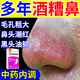 酒糟鼻專用紅腫長(zhǎng)痘毛孔粗大草莓鼻紅鼻子血絲玫瑰痤瘡膏藥貼酒槽鼻酒渣鼻鼻頭粉刺黑頭螨蟲 化瘀祛斑膠囊 1盒【鼻子毛孔粗大】 （發(fā)貨特效率）