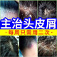 復(fù)方酮康唑洗劑洗發(fā)水去頭皮屑去屑止癢皮炎毛囊炎脂溢性皮炎頭皮屑洗發(fā)水頭皮癬頭屑頭癢頭皮癬真菌感染 3盒 【頭皮屑多 頭皮瘙癢 脂溢性皮炎】