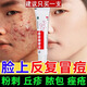 紅霉素軟膏藥祛痘膏祛痘印修復淡化痘印痘坑修復藥膏滿(mǎn)臉痘學(xué)生青春痘去痘痘改善粉刺閉口紅霉素軟膏 1盒  【紅腫膿包疙瘩痘】