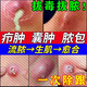 拔毒藥膏火癤子膿包疙瘩皮脂腺囊腫瘡癤火癤子特專用效藥軟膏面部頭部癤腫囊腫消硬塊皮膚用藥莫匹羅星軟膏 1盒【火癤子膿包專用藥】