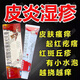 999三九 皮炎平復方醋酸地塞米松乳膏20g 局部性皮膚瘙癢癥快速止癢神經性接觸性脂溢性皮炎慢性濕疹 1盒【皮膚局部瘙癢 起紅疙瘩】20g/建議療程裝