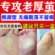 去腳底老繭去硬皮腳底老繭去除根特治療效藥腳掌繭子雞眼腳墊神器腳后跟死皮軟化角質(zhì)增生皮膚用藥水楊酸軟膏 1盒裝【老繭消滅在萌芽期】100%正品