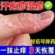 汗皰疹100%特高效藥濕疹特專(zhuān)用效藥止癢去氣根瘙癢手上起水泡癢用什么藥真菌感染皮膚用藥阿昔洛韋乳膏 2盒【手上漢泡疹瘙癢潰爛】一抹止癢 當(dāng)時(shí)見(jiàn)效