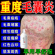 芙詩(shī)婷毛囊清潔洗發(fā)水毛囊I炎去屑止癢除螨抑菌祛痘控油男女通用洗發(fā)露 3瓶【優(yōu)惠裝】