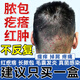 痤瘡膏祛痘膿皰瘡毛囊炎藥膏頭皮癢后背真菌頭皮屑多毛囊炎頭部專(zhuān)用藥復方醋酸地塞米松乳膏主圖視覺(jué)特效 1盒裝