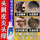復(fù)方酮康唑洗劑洗發(fā)水去頭皮屑去屑止癢皮炎毛囊炎脂溢性皮炎頭皮屑洗發(fā)水頭皮癬頭屑頭癢頭皮癬真菌感染 1盒 【國藥準(zhǔn)字 去屑洗發(fā)水】